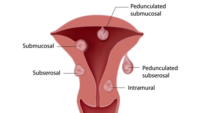 fibroid causing spotting after period ends