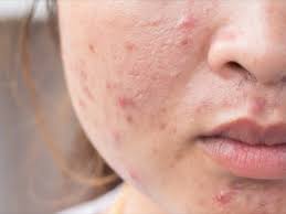 acne period