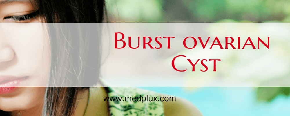 Burst Ovarian Cyst Causes, Sign, Symptoms, What To Do If Cyst Bursts