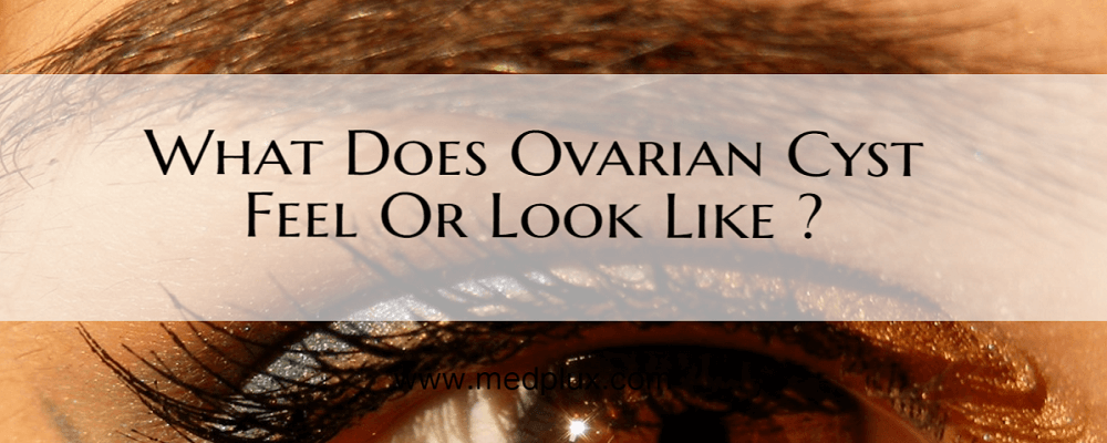 What Does An Ovarian Cyst Feel Like Or Looks Like (Pictures)