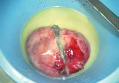 What Does An Ovarian Cyst Looks Like (Pictures)