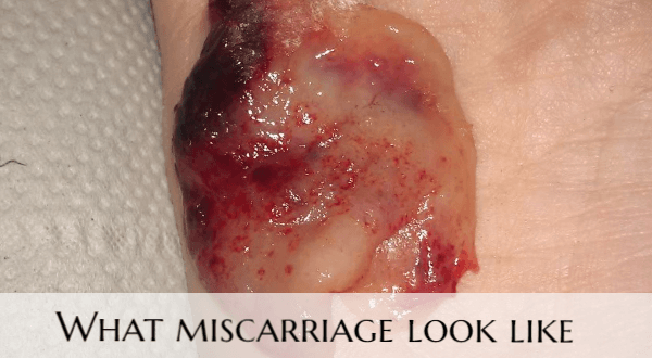 What does miscarriage at 9 weeks look like (pictures)