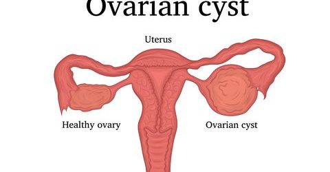 ovarian cyst picture