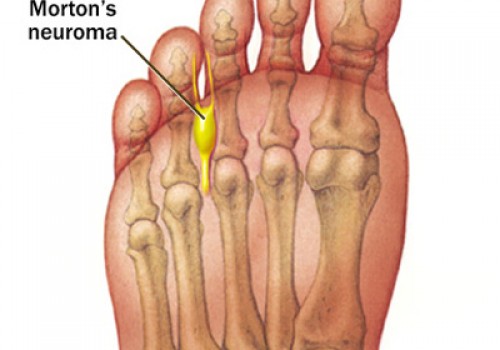 bottom foot pain near toes