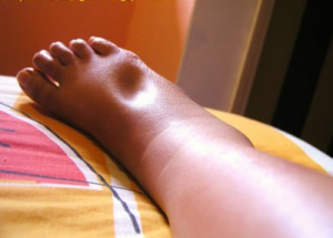 pregnancy top of foot swelling
